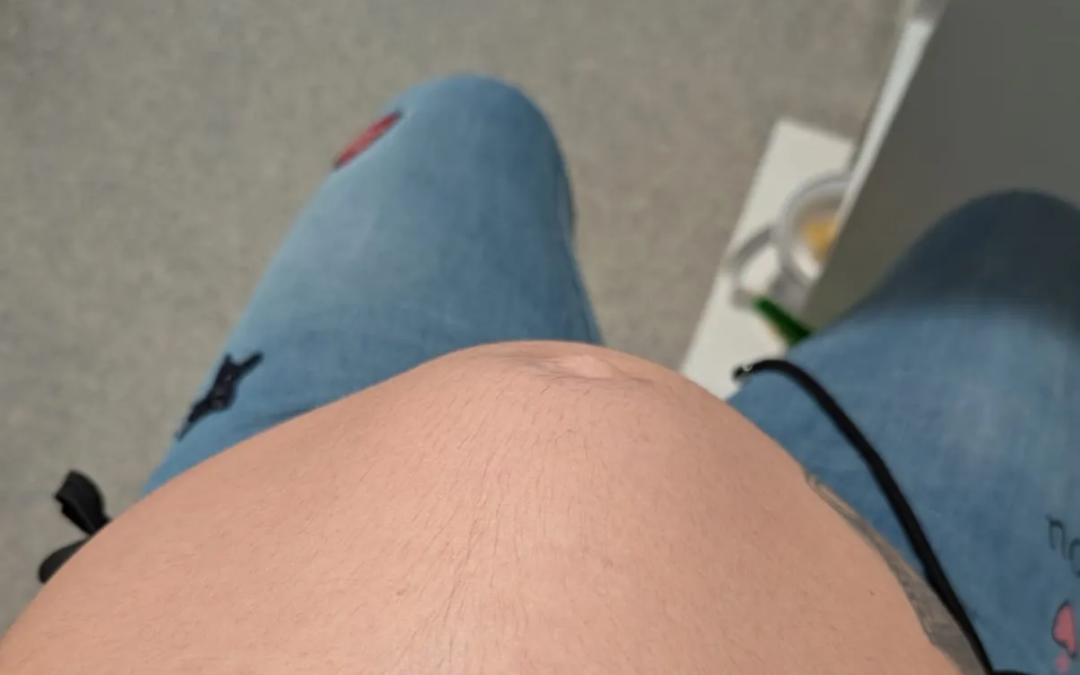 “Vi un bulto en mi abdomen”: el susto de Elisa y cómo evitar una diástasis patológica en el embarazo