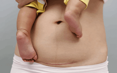 Recuperar el abdomen y suelo pélvico tras cesárea: la historia real de Ana